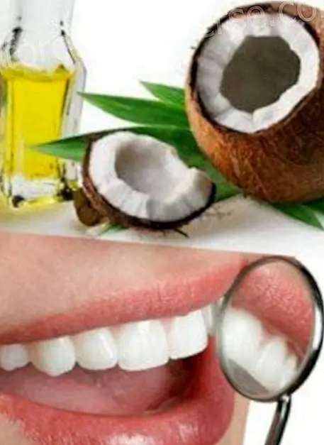 नारियल का तेल दांतों की सड़न पैदा करने वाले बैक्टीरिया को दूर करने में मदद करता है - चैतन्य जीवन