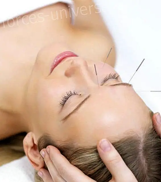 Beneficis de l'acupuntura
