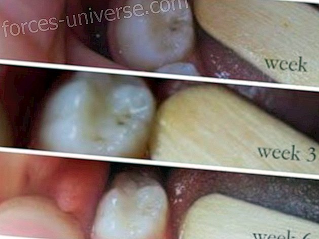 Cavities can heal naturally - Conscious Life